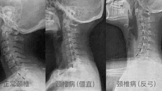 搜狗订阅:澳门一码一码100准确-颈椎反弓是什么意思