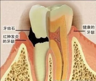 微博:澳彩资料免费资料大全-牙周炎是什么症状