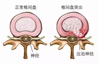 阿里巴巴:新澳精选资料免费提供-椎间盘膨出是什么意思