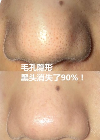 微博:王中王最准一肖100免费公开-黑头是什么