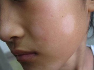 知乎：2o24澳门正版精准资料-白癜风有什么症状