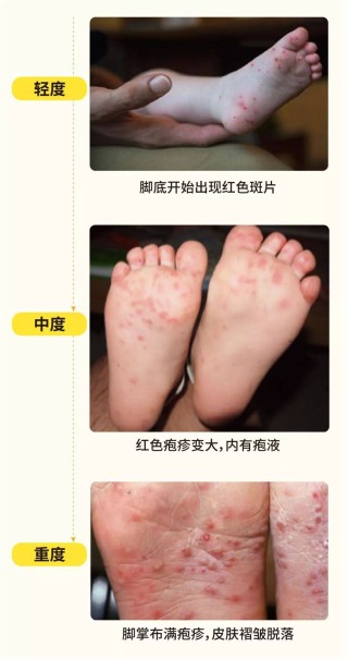 搜狐:澳门王中王100%的资料2024-手足口病什么症状