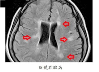 百度平台:4777777澳门开奖结果查询十几-脱髓鞘病变是什么意思