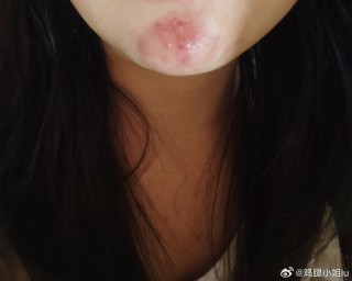 微博:7777788888一肖一码-下巴下面长痘痘是什么原因