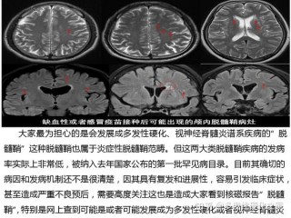 百度平台:4777777澳门开奖结果查询十几-脱髓鞘病变是什么意思