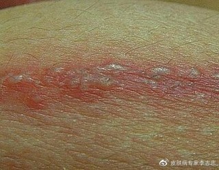 搜狐:4949退库-资料香港2024-疱疹是什么症状