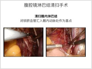 腾讯：新奥资料免费精准-淋巴结清扫是什么意思