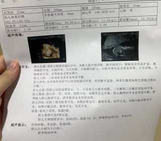 抖音视频:2024年新澳门必开32期一肖-中期唐氏筛查查什么
