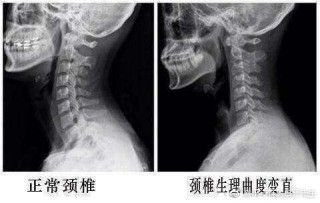 搜狗订阅:澳门一码一码100准确-颈椎反弓是什么意思