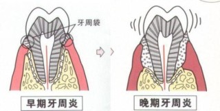 微博:澳彩资料免费资料大全-牙周炎是什么症状