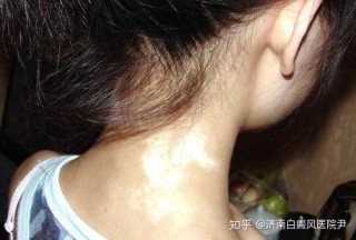 知乎：2o24澳门正版精准资料-白癜风有什么症状