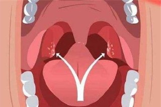 火山视频:今晚澳门三肖三码开一码-急性化脓性扁桃体炎吃什么药