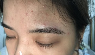 火山视频:2024香港正版挂牌-眉毛里面长痘痘是什么原因
