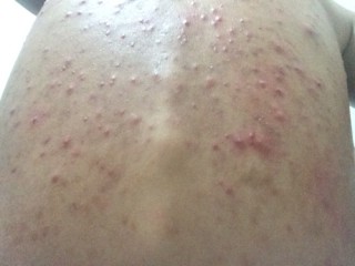 百家号:4949澳门资料免费大全高手-身上起红疙瘩很痒是什么原因