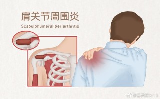 腾讯：2024年澳门今晚开码料-肩周炎有什么症状