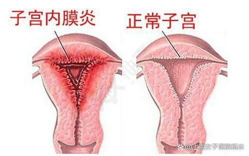 火山视频:香港一肖一码公开免费资料-子宫发炎是什么原因引起的