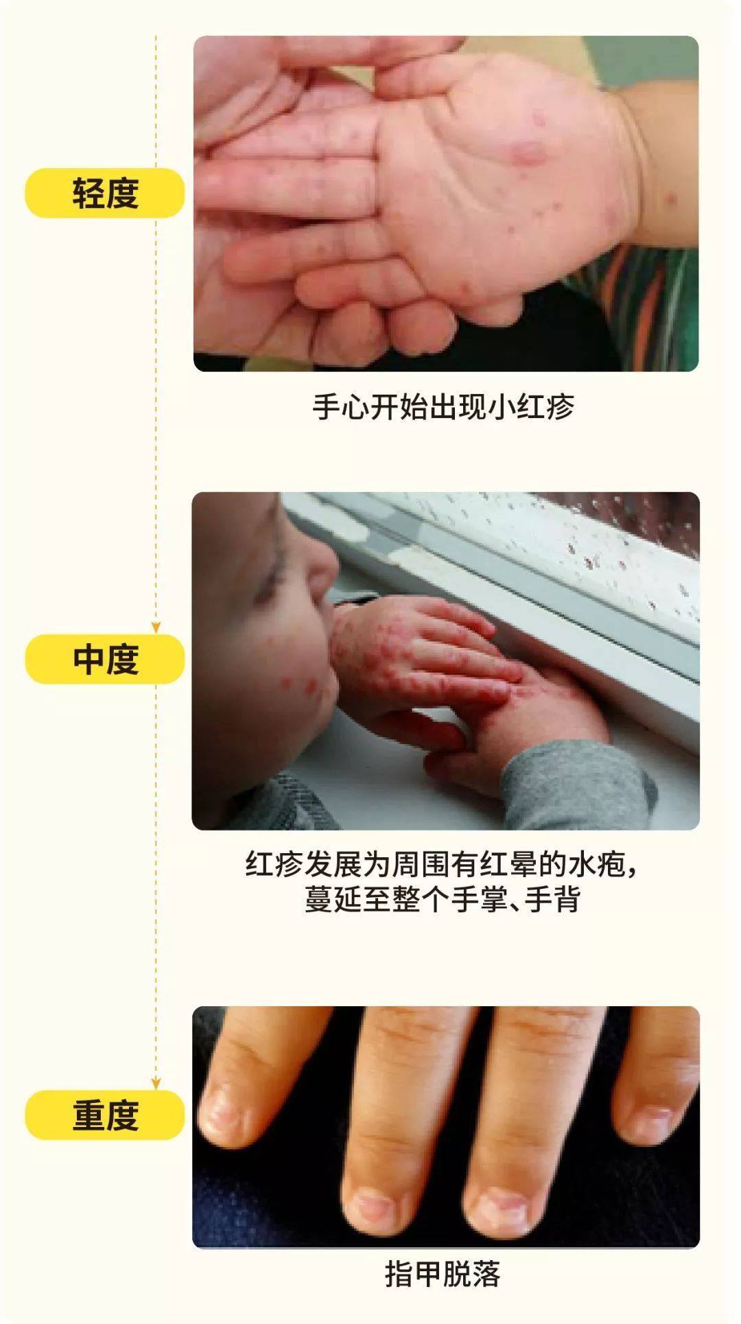 搜狐:澳门王中王100%的资料2024-手足口病什么症状