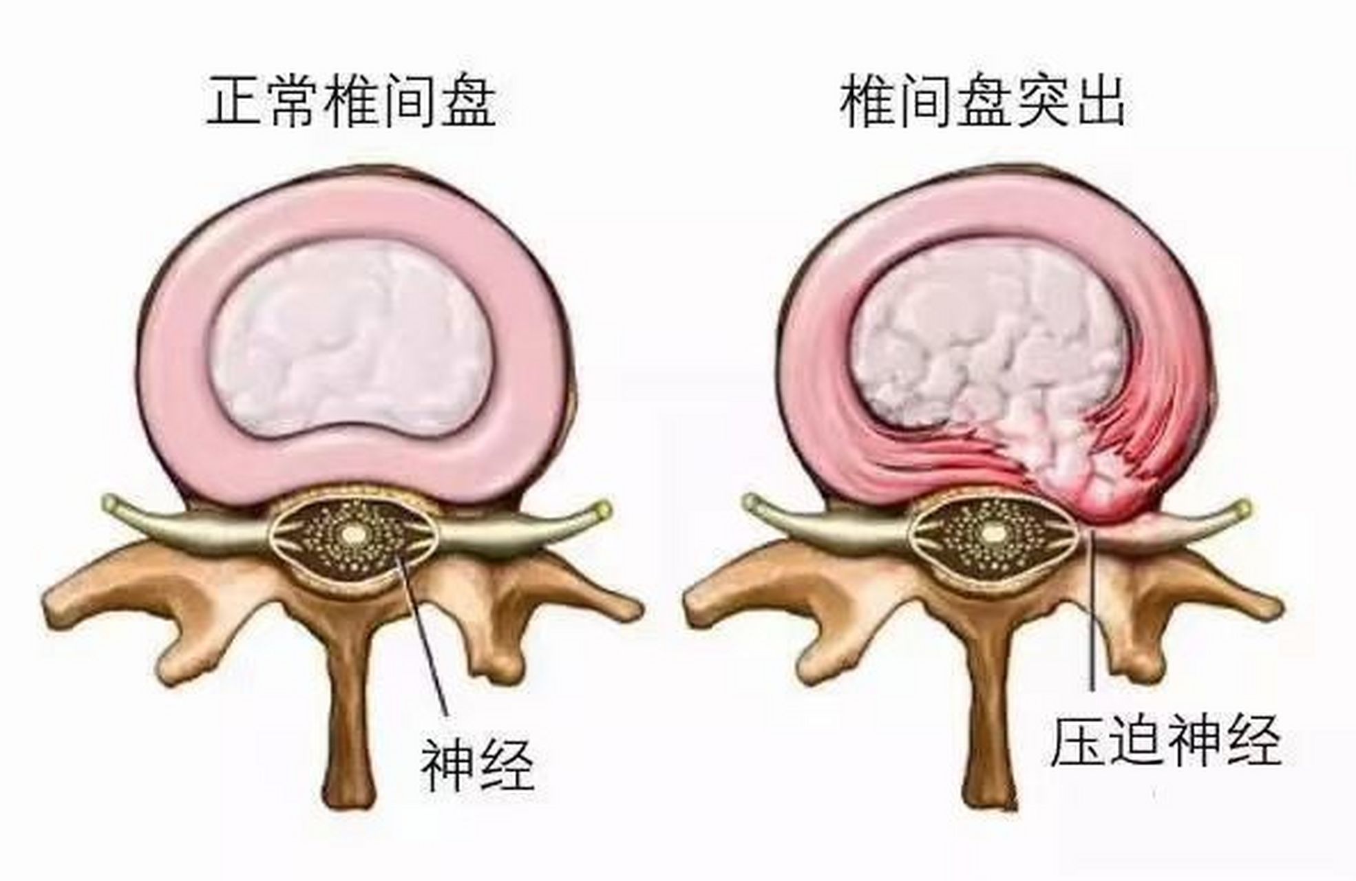 阿里巴巴:新澳精选资料免费提供-椎间盘膨出是什么意思