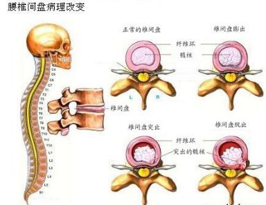 阿里巴巴:新澳精选资料免费提供-椎间盘膨出是什么意思