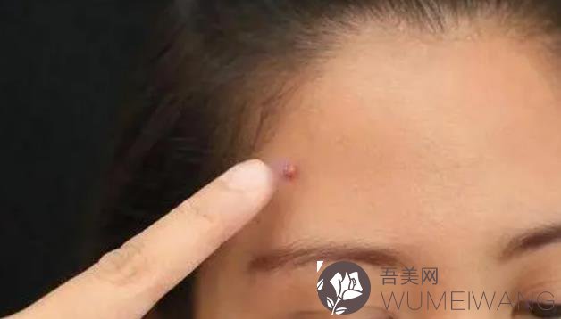 火山视频:2024香港正版挂牌-眉毛里面长痘痘是什么原因