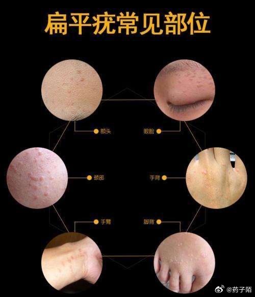 抖音视频:2024年正版资料免费大全-扁平疣用什么药膏管用