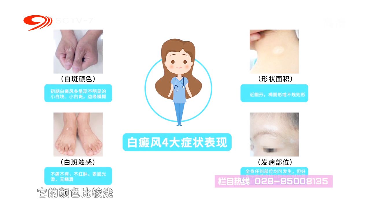 知乎：2o24澳门正版精准资料-白癜风有什么症状