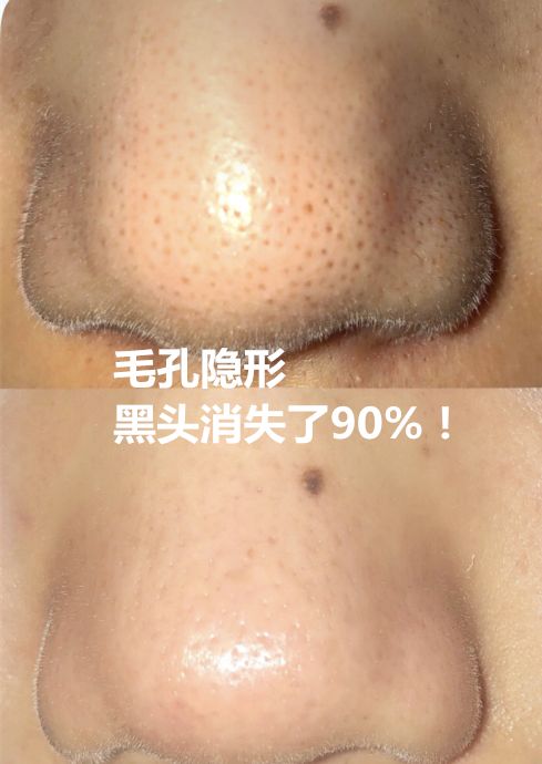 微博:王中王最准一肖100免费公开-黑头是什么