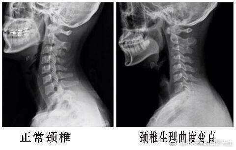 搜狗订阅:澳门一码一码100准确-颈椎反弓是什么意思
