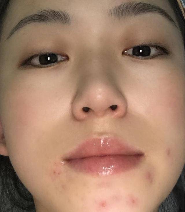 微博:7777788888一肖一码-下巴下面长痘痘是什么原因
