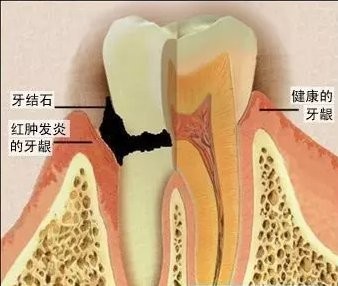 微博:澳彩资料免费资料大全-牙周炎是什么症状