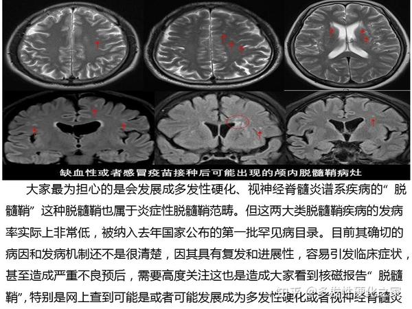 百度平台:4777777澳门开奖结果查询十几-脱髓鞘病变是什么意思
