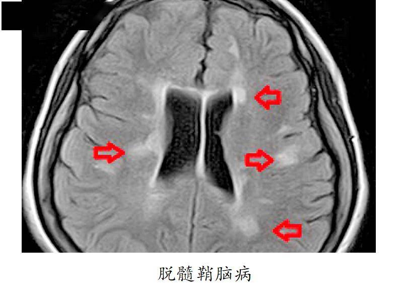 百度平台:4777777澳门开奖结果查询十几-脱髓鞘病变是什么意思