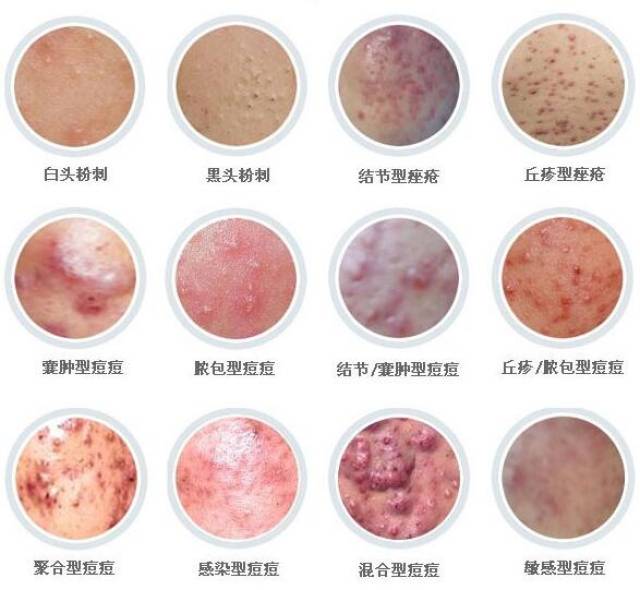 微博订阅:新澳好彩免费资料查询-脸颊长痘痘什么原因
